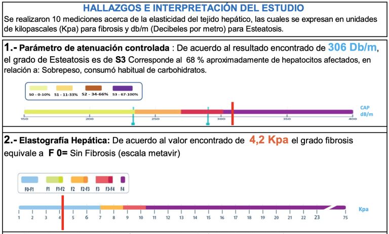 Elastografía hepática