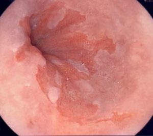 Esófago de Barrett 2 (1)