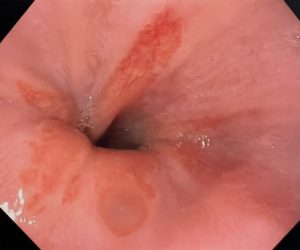 Esófago de Barrett 3 (1)