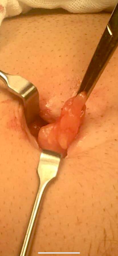 Hernia umbilical 1