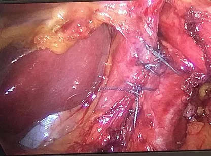 cirugia-hernia-hiatal