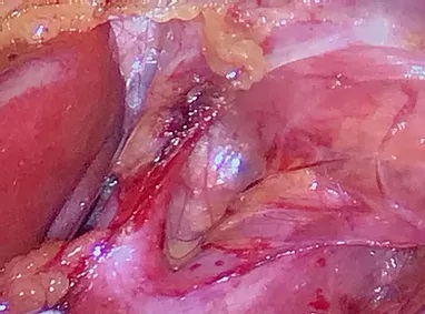 cirugia-hernia-hiatal_JPG