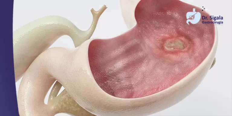 Úlcera Gástrica