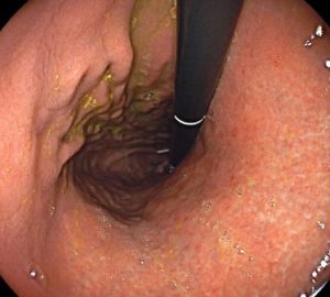 Gastritis crónica (1)